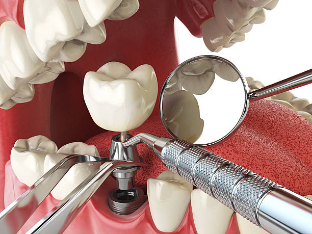 Best Emergency Dentist for Lost Fillings or Crowns in Godfrey, IL